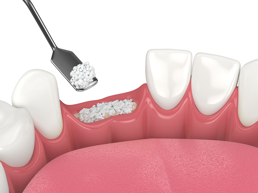 Enhancing Oral Health with Bone Grafting in Oklahoma City, OK